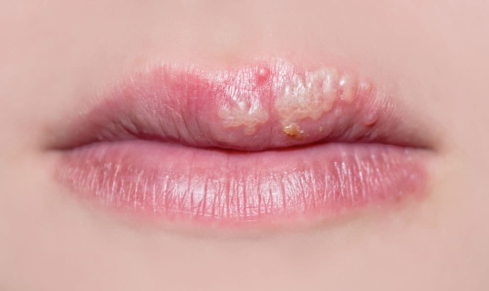 Læben svamp på Forkølelsessår (herpes)