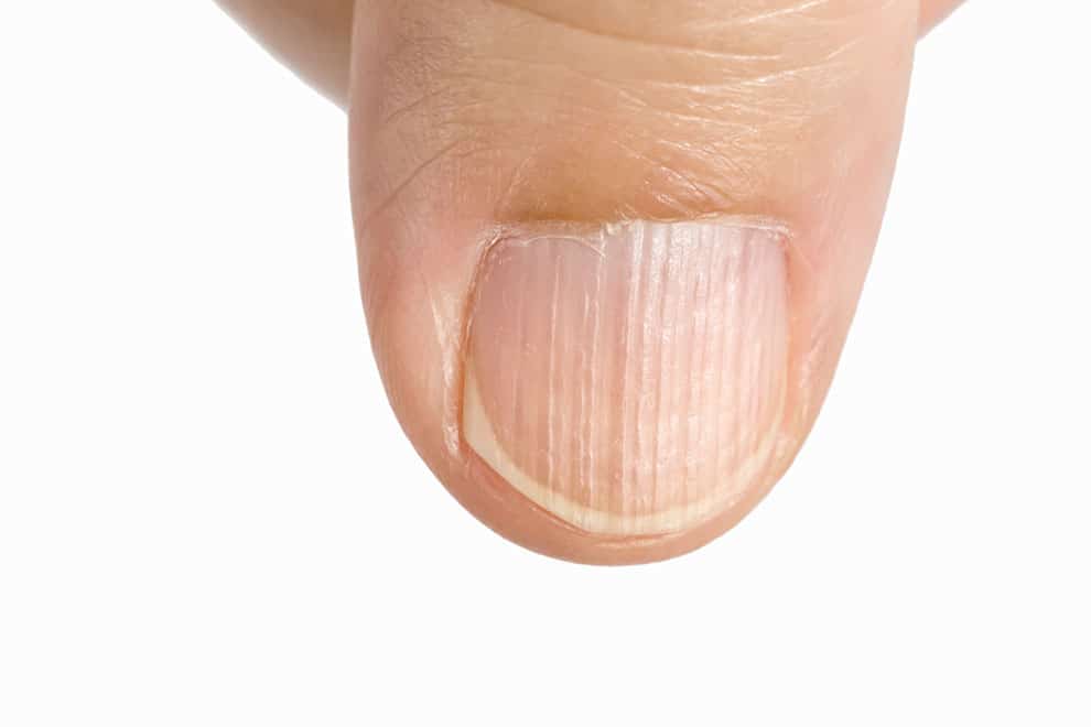 besøgende Vittig overgive Hvad fortæller dine negle om dit helbred? - Helsenyt