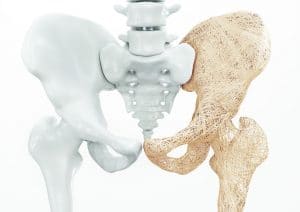 Porøse knogler øger risikoen for knoglebrud